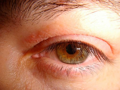 Lower eyelid redness and swelling